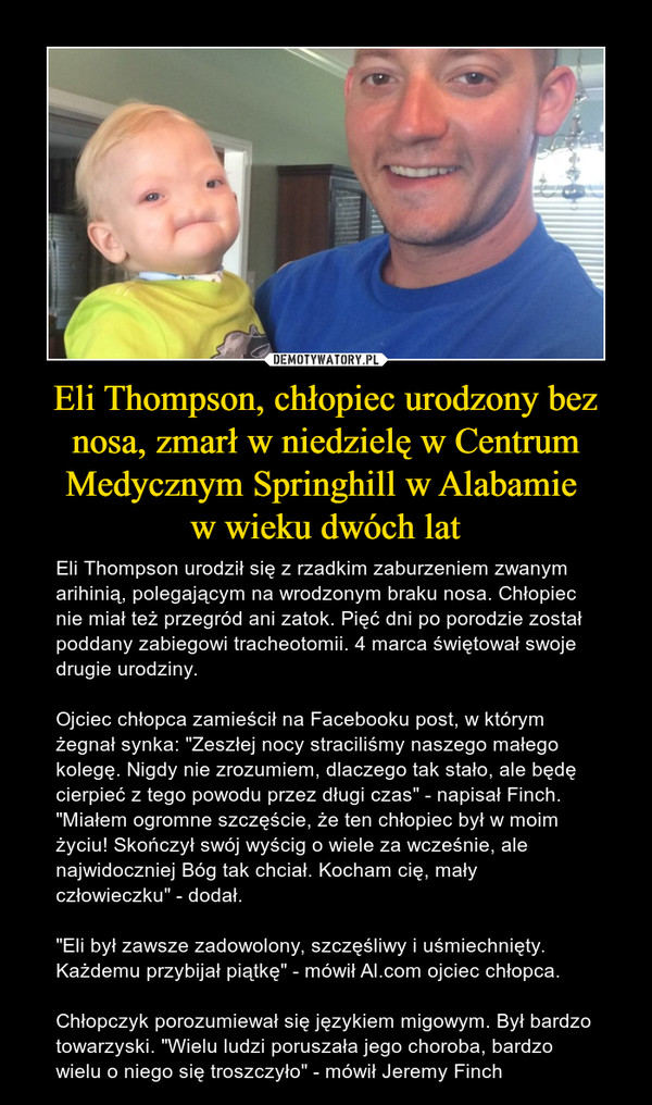 Eli Thompson, chłopiec urodzony bez nosa, zmarł w niedzielę w Centrum Medycznym Springhill w Alabamie 
w wieku dwóch lat