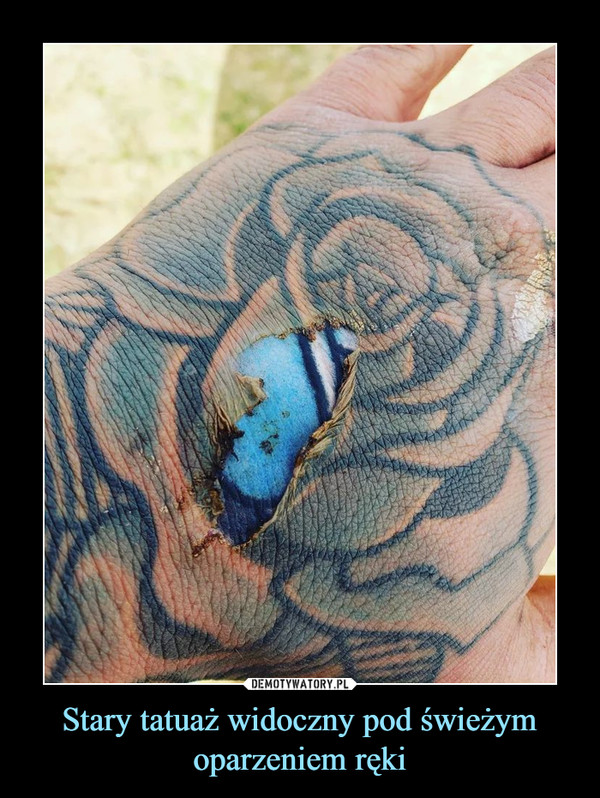 Stary tatuaż widoczny pod świeżym oparzeniem ręki