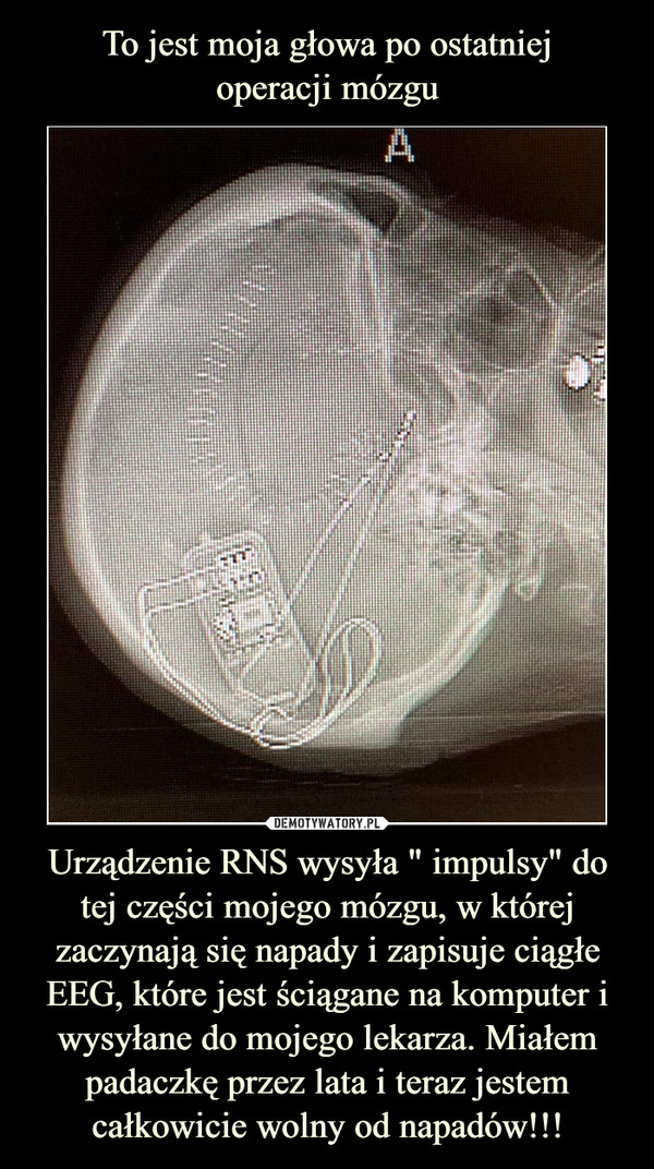 Urządzenie RNS wysyła " impulsy" do tej części mojego mózgu, w której zaczynają się napady i zapisuje ciągłe EEG, które jest ściągane na komputer i wysyłane do mojego lekarza. Miałem padaczkę przez lata i teraz jestem całkowicie wolny od napadów!!! –  