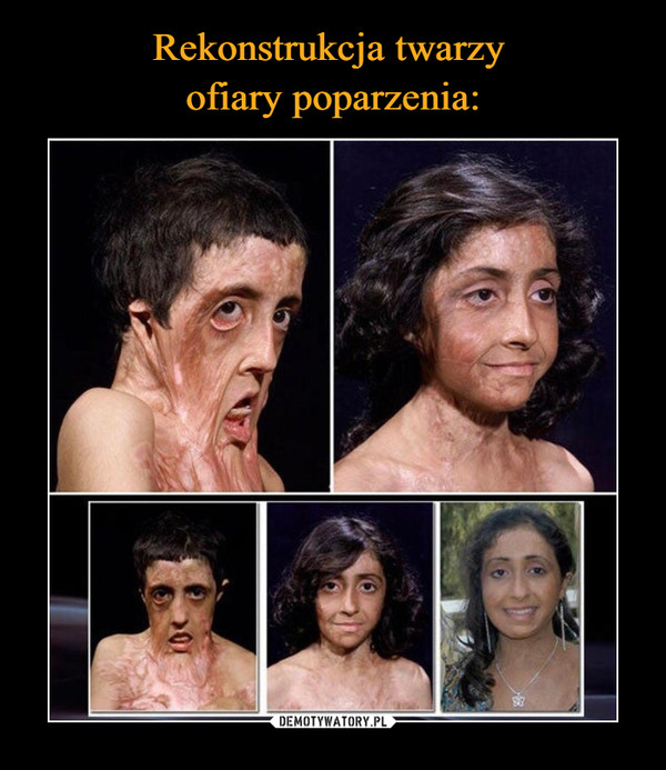 Rekonstrukcja twarzy 
ofiary poparzenia: