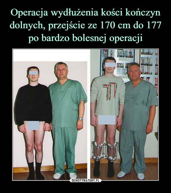 Operacja wydłużenia kości kończyn dolnych, przejście ze 170 cm do 177 po bardzo bolesnej operacji
